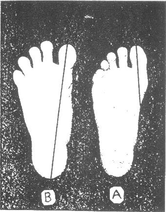 normal foot