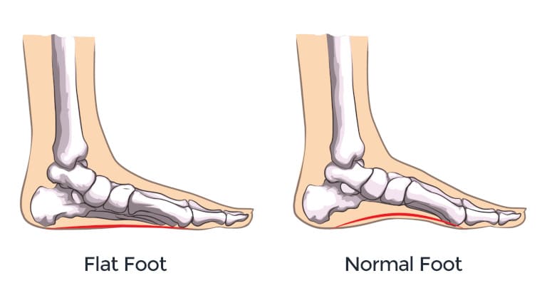 Flat foot versus normal foot