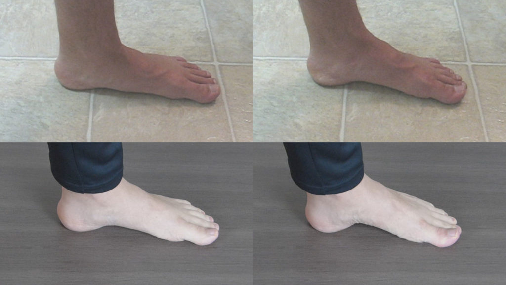 Short foot exercises progress